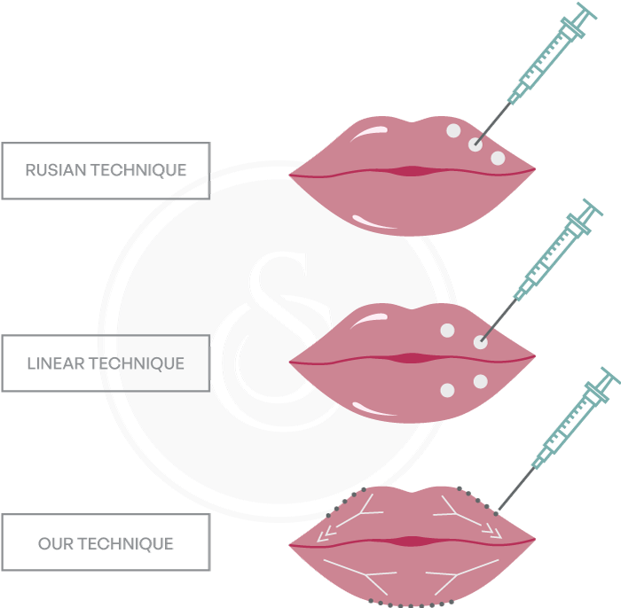 Sarasin Clinic lip filler technieken