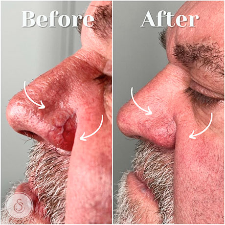 Spider Vein Removal FACE before and after