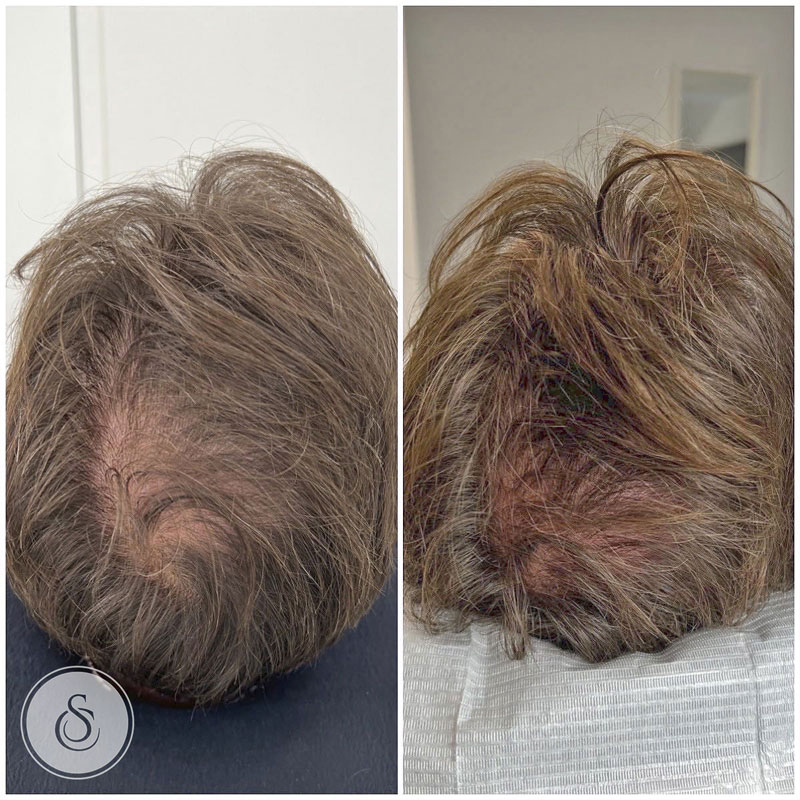 Clinique Sarasin Remplisseur de cheveux homme avant et après