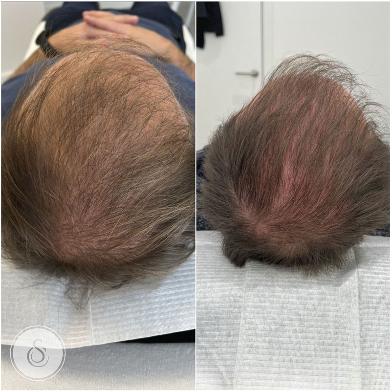 Clinique Sarasin Remplisseur de cheveux homme avant et après