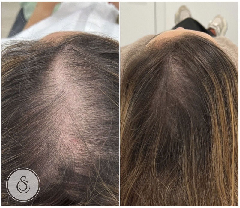 Clinique Sarasin Remplissage capillaire femme avant et après