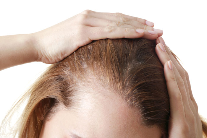 Sarasin Clinic Haarverlies vrouwen