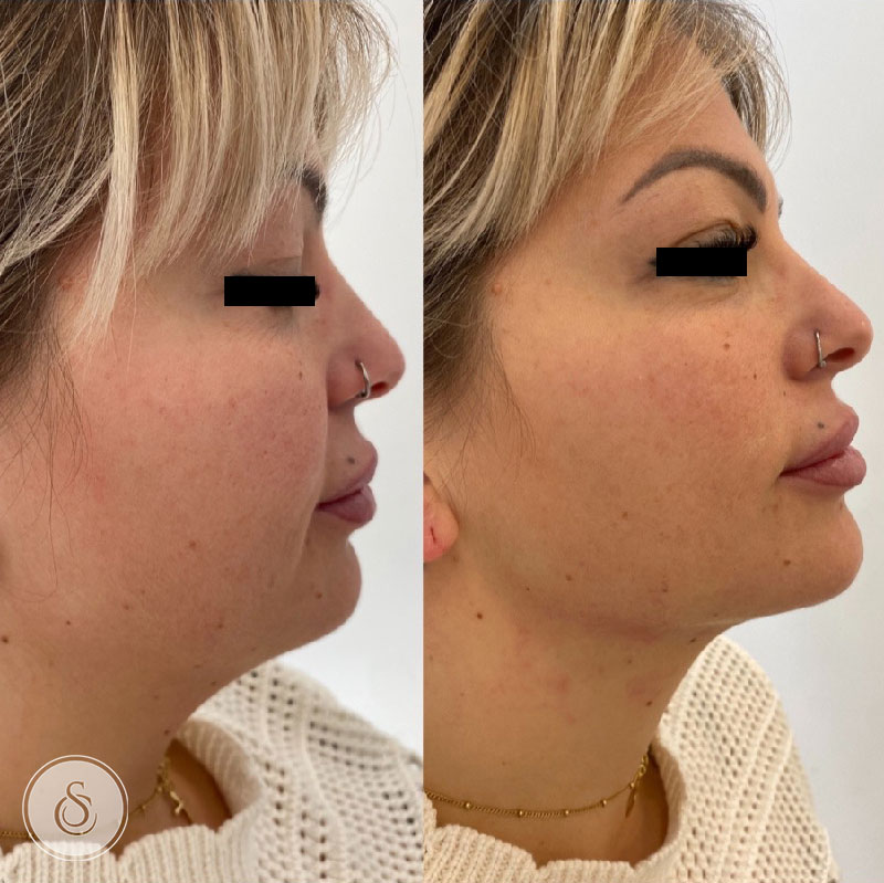 Ultra Lift Skin (HIFU) - Non-Surgical and Non-Invasive Treatment