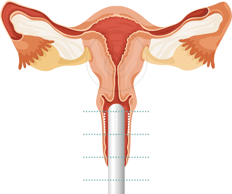 Sarasin Clinic Hifu Vagina
