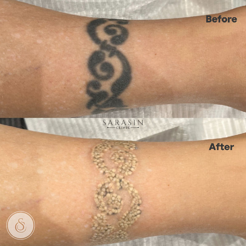 9 To 7 Pm Laser Tattoo Removal Treatment Chennai