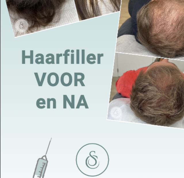 cropped-SarasinClinic_hairfiller-before-and-after-STORY_01.png