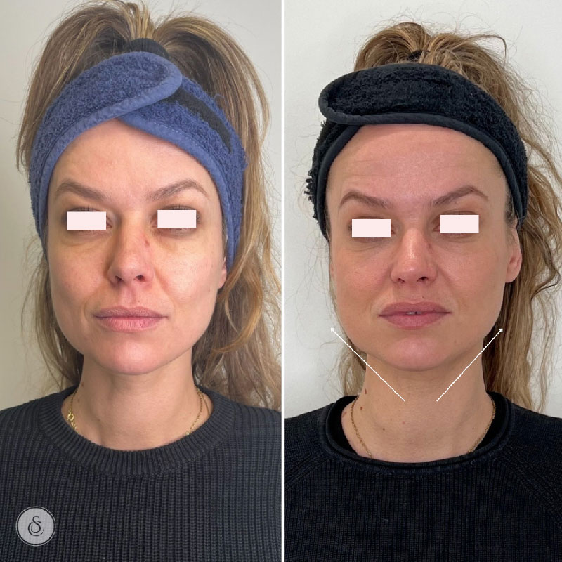 Clinique Sarasin hifu visage complet avant et après