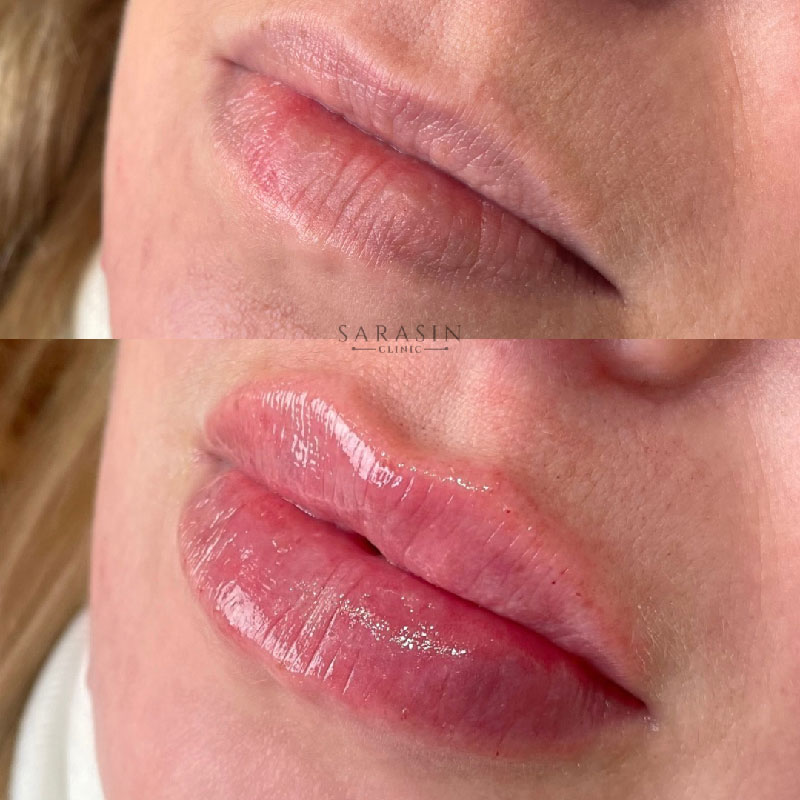 Lip fillers - Beautifully shaped sexy lips at Sarasin Clinic