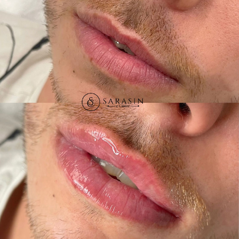 Clinique Sarasin, lip filler avant et après homme