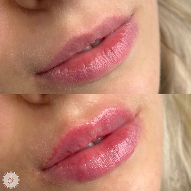 Clinique Sarasin - Comblement des lèvres avant et après