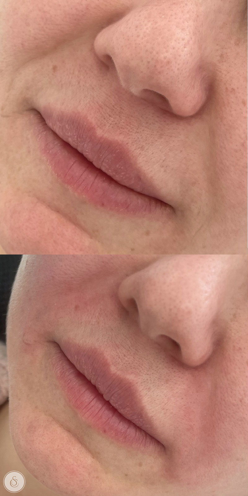 Clinique Sarasin - Comblement des plis de la lèvre nasale