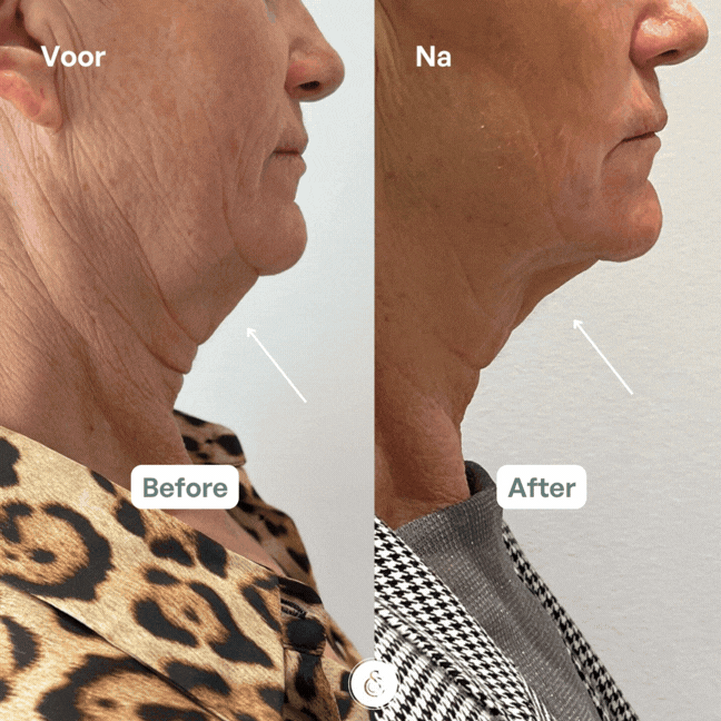 botox nefertiti necklift resultaten sarasin clinic