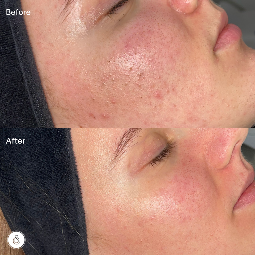 Sébium Pore refiner  Acne scar treatment, face day cream for oily skin