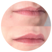 Hydratation des lèvres de Sarasin