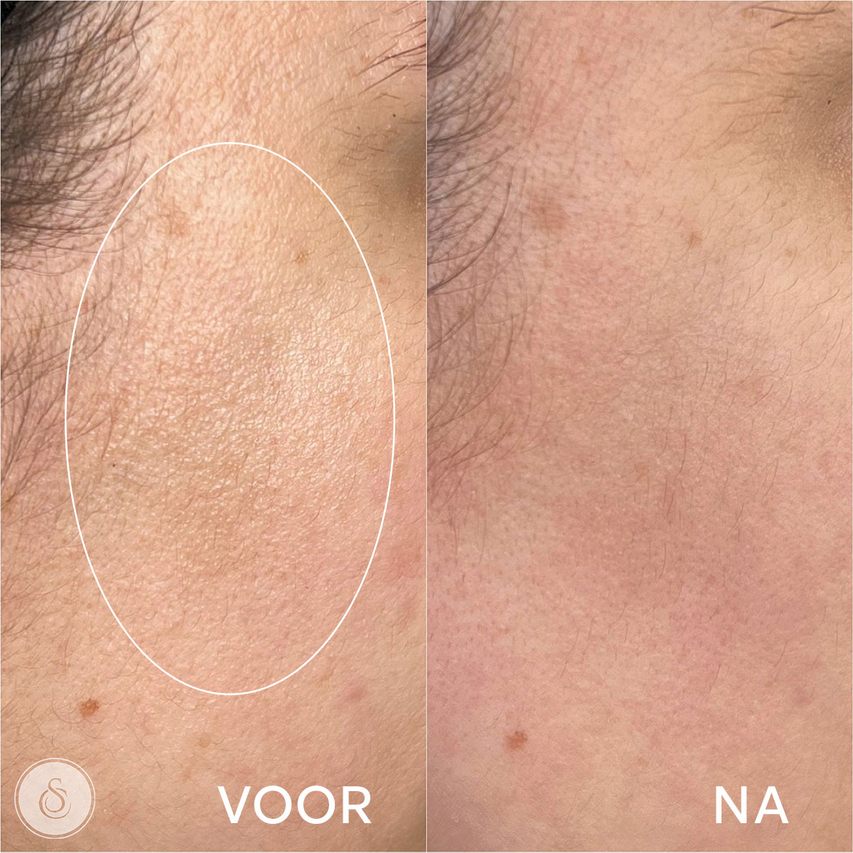 Clinique Sarasin Aquashine pores dilatés avant et après