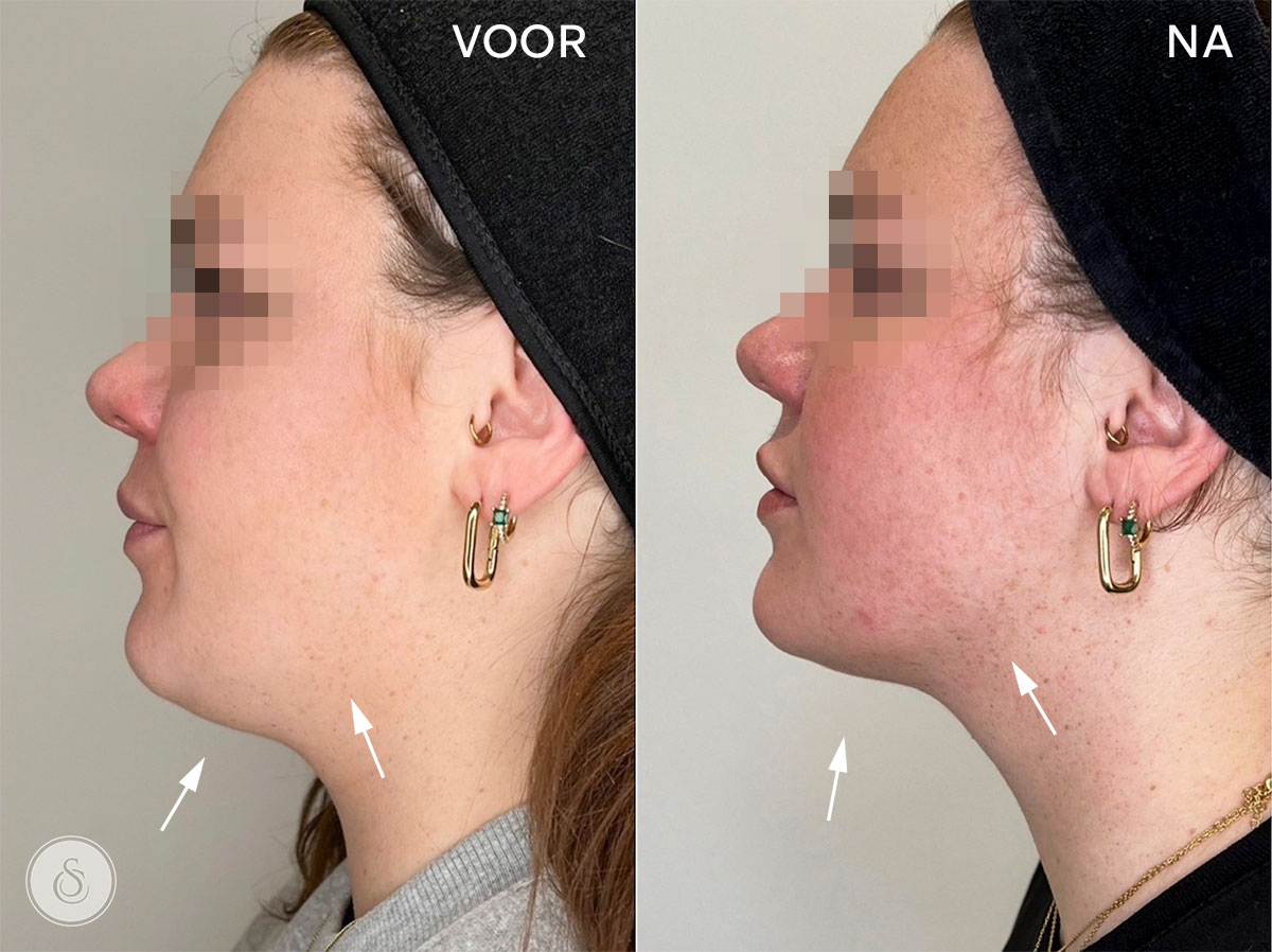 Sarasin Clinic Lipolysis Chubby Chin package before and after