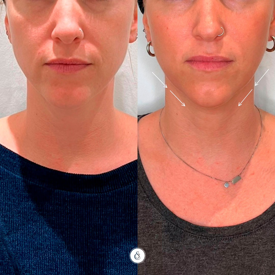 SarasinClinic_Nefertiti-Halslift_Face-Slimming-frontaal-close-up Sarasin Clinic Nefertiti Halslift Face Slimming frontaal close up