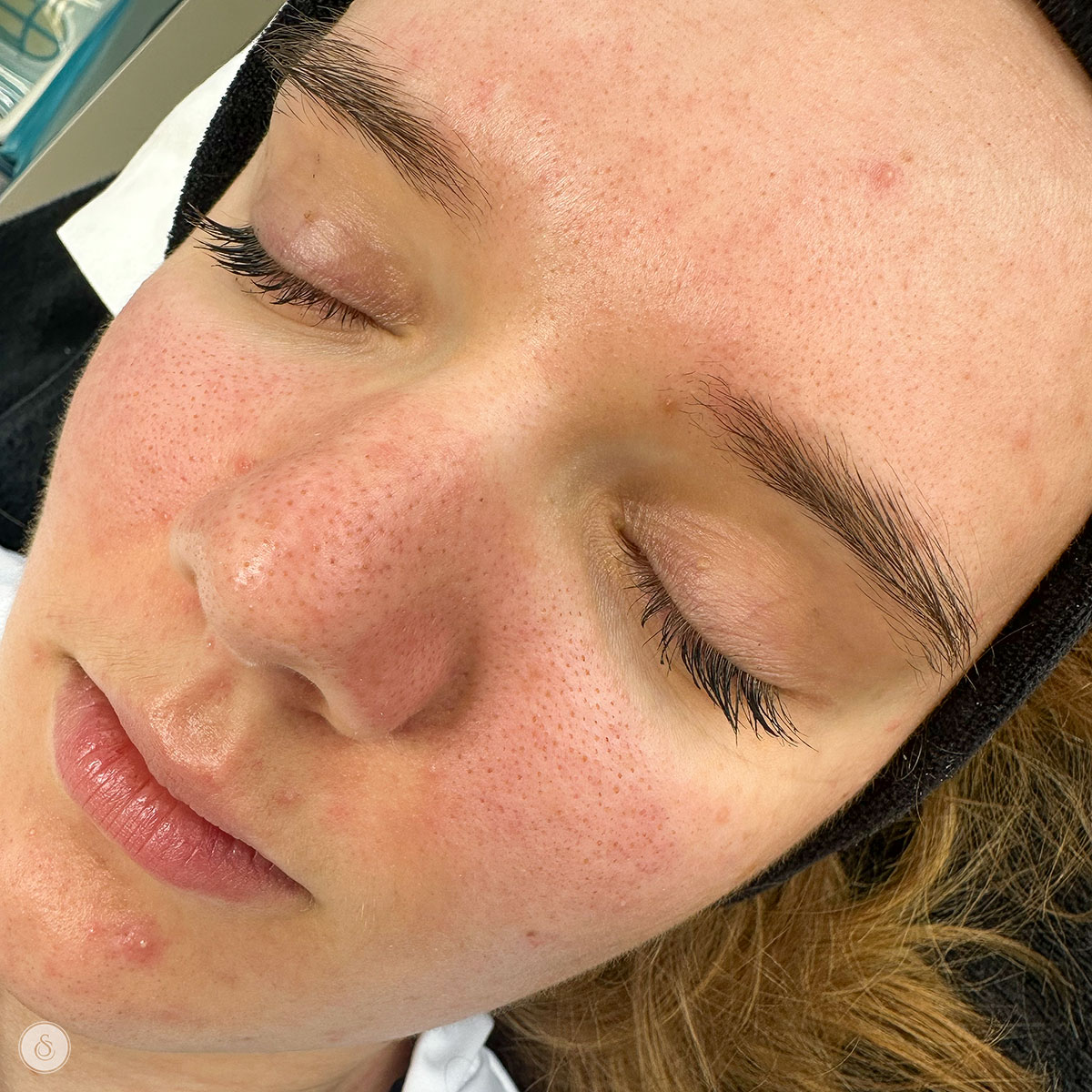Sarasin Clinic large pores face