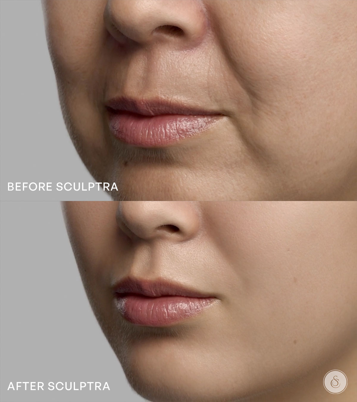 Sarasin Clinic Sculptra before after