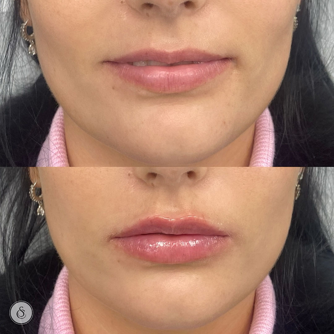 Sarasin Clinic lip balancing with lipfiller