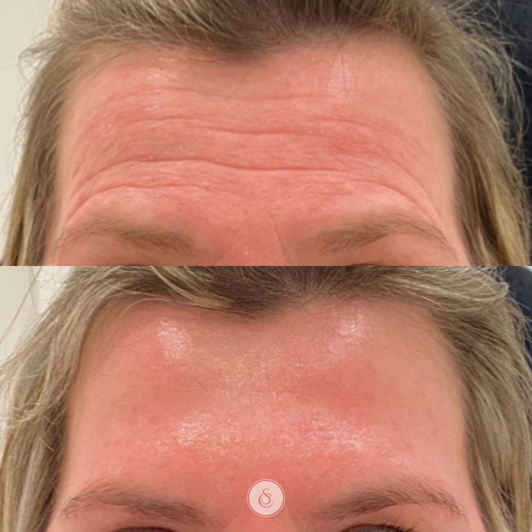 Sarasin Clinic botox forehead