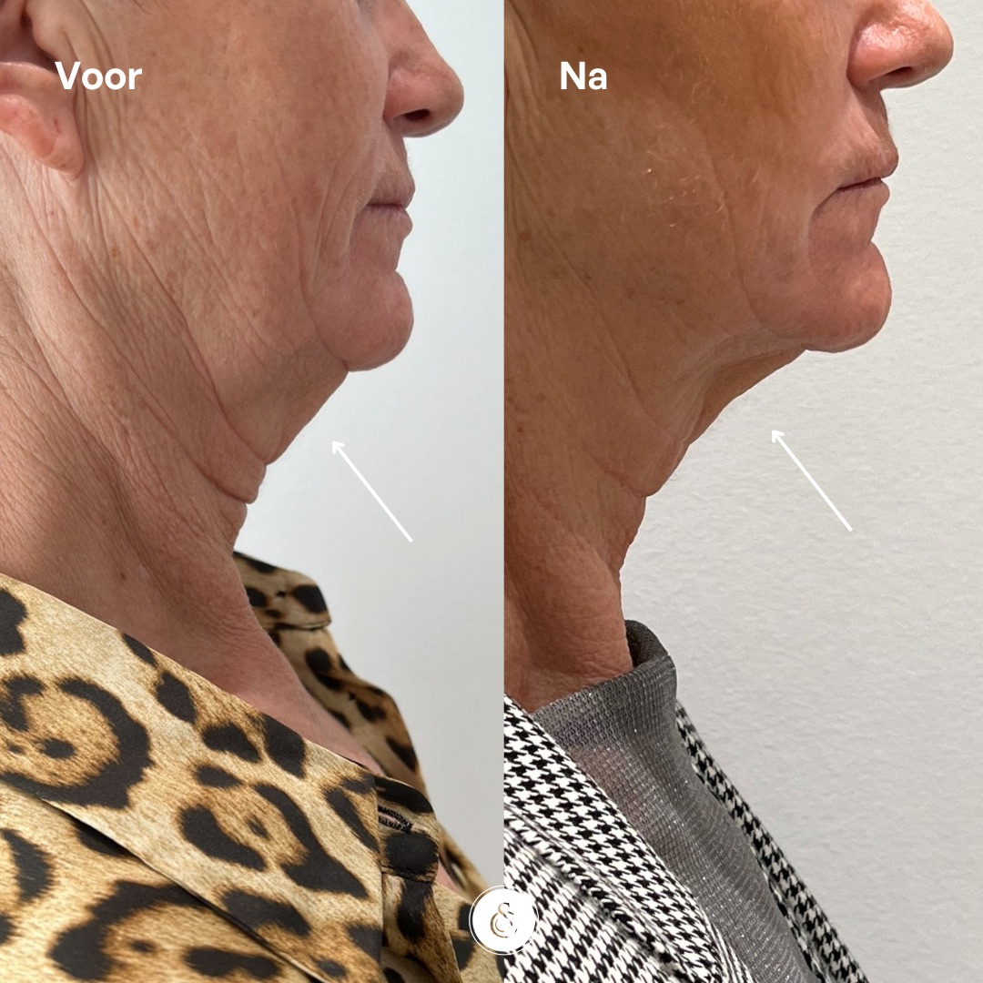 btx nefertiti neck elevator before and after