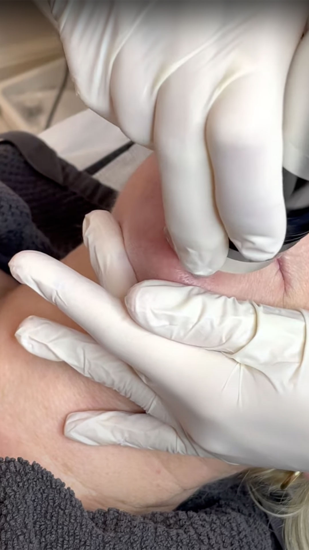 SarasinClinic_video-Microneedling-Demonstratie2