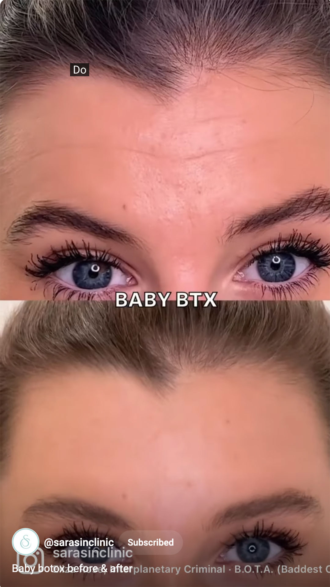SarasinClinic_video_Baby-botox-before-after