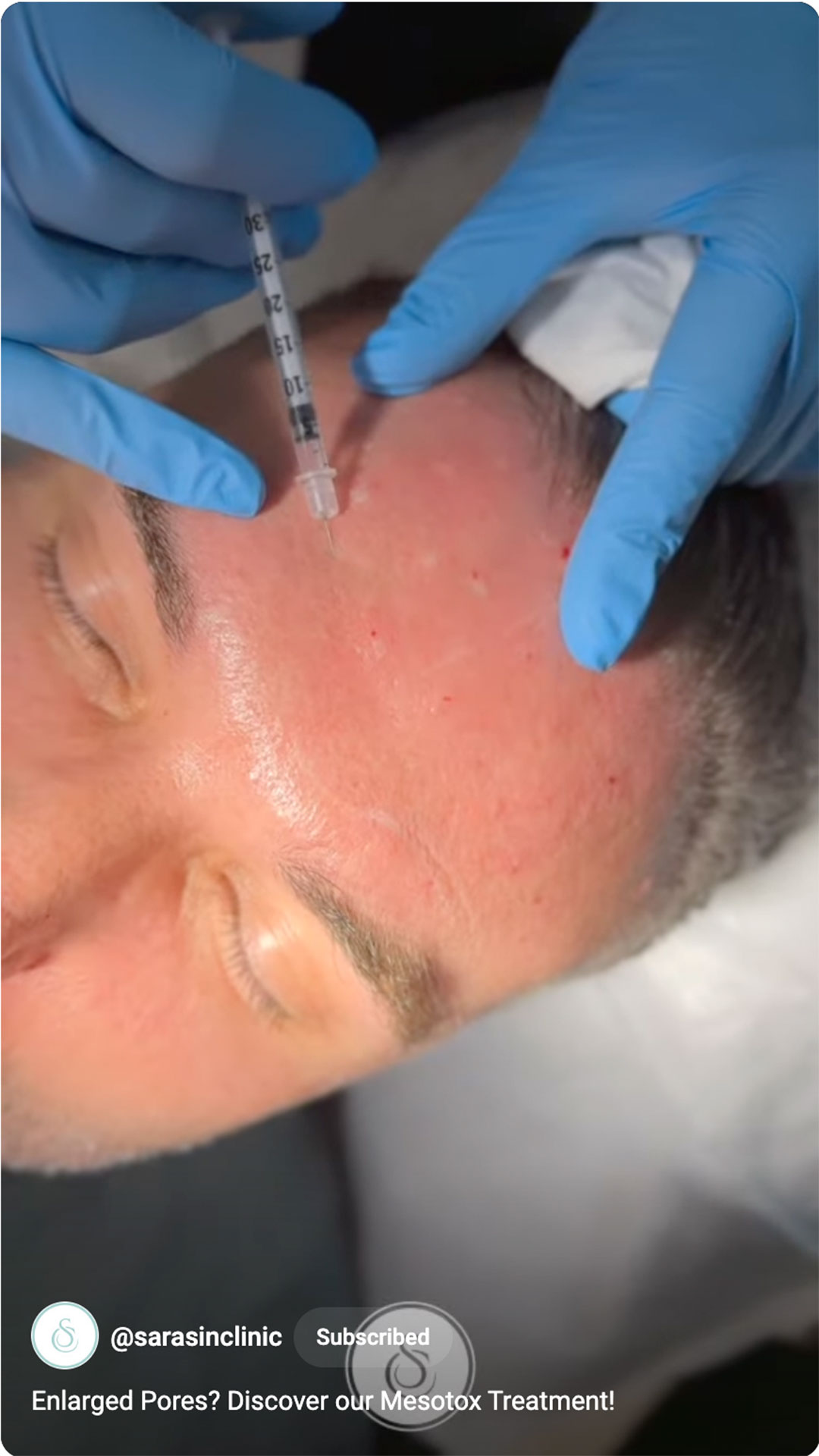 SarasinClinic_video_Enlarged-Pores-Discover-our-Mesotox-Treatment