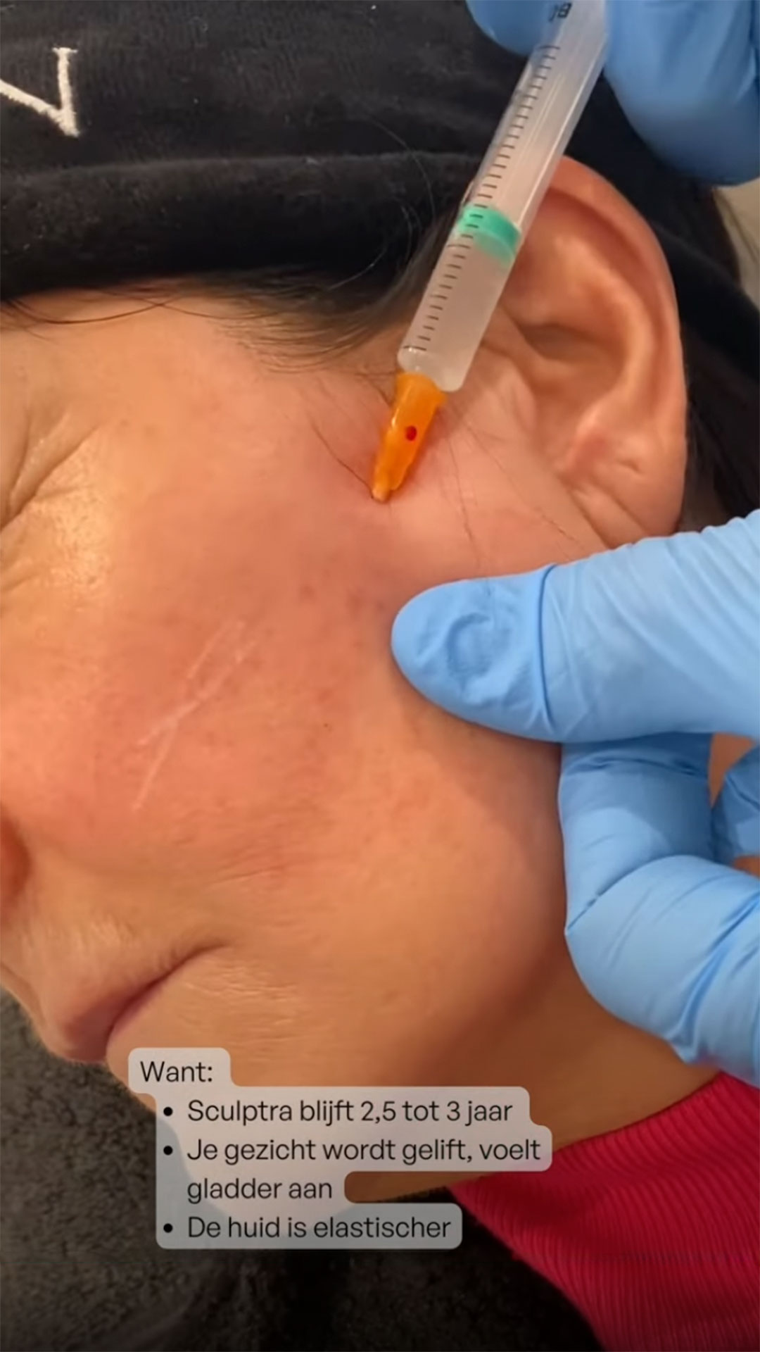 SarasinClinic_video_Hoe-verloopt-de-sculptra-behandeling