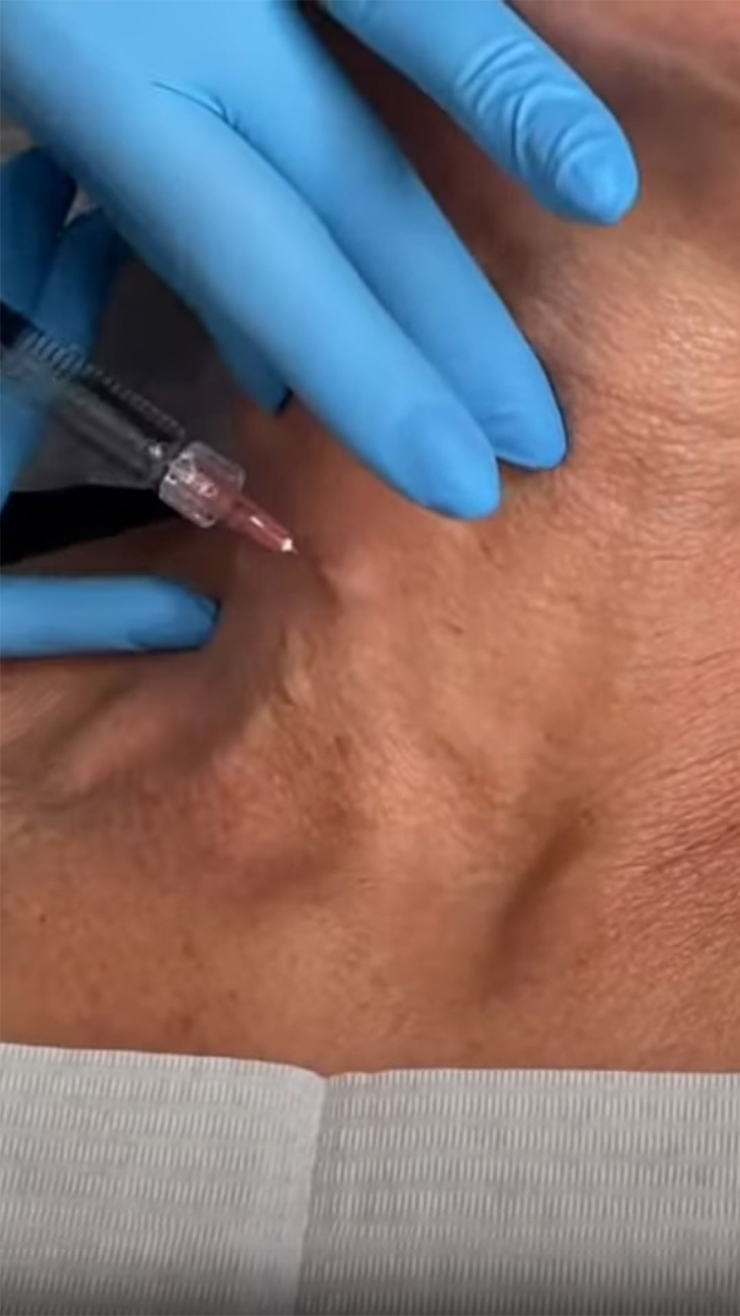 SarasinClinic_video_Profhilo-Treatment