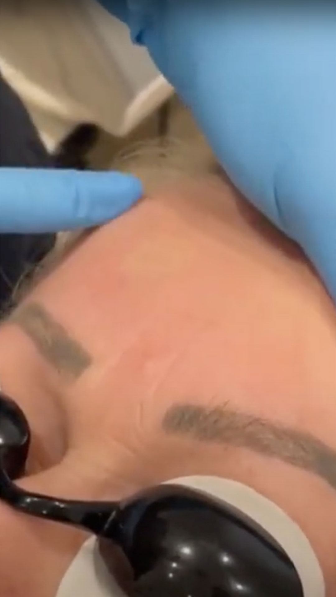 SarasinClinic_video_Removal-of-killer-brows