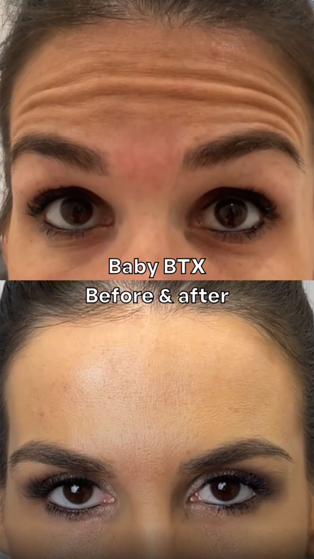 SarasinClinic_video_Sarasin-Clinic-baby-Botox-before-after