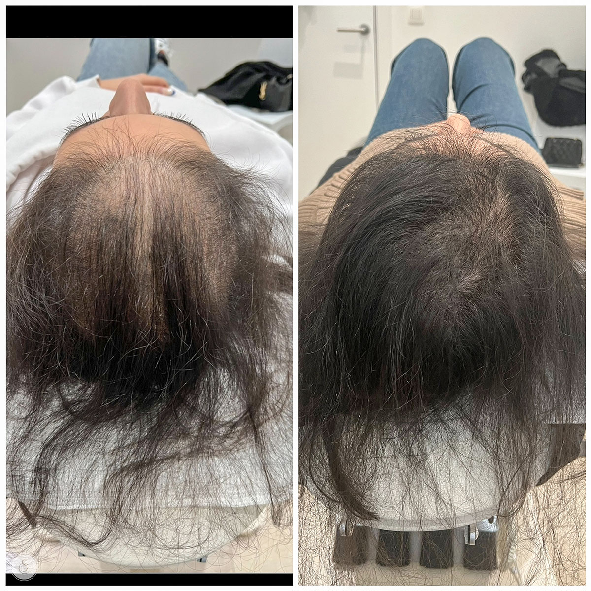 Sarasin Clinic haarfiller vrouw tussentijds resultaat na 5 sessies