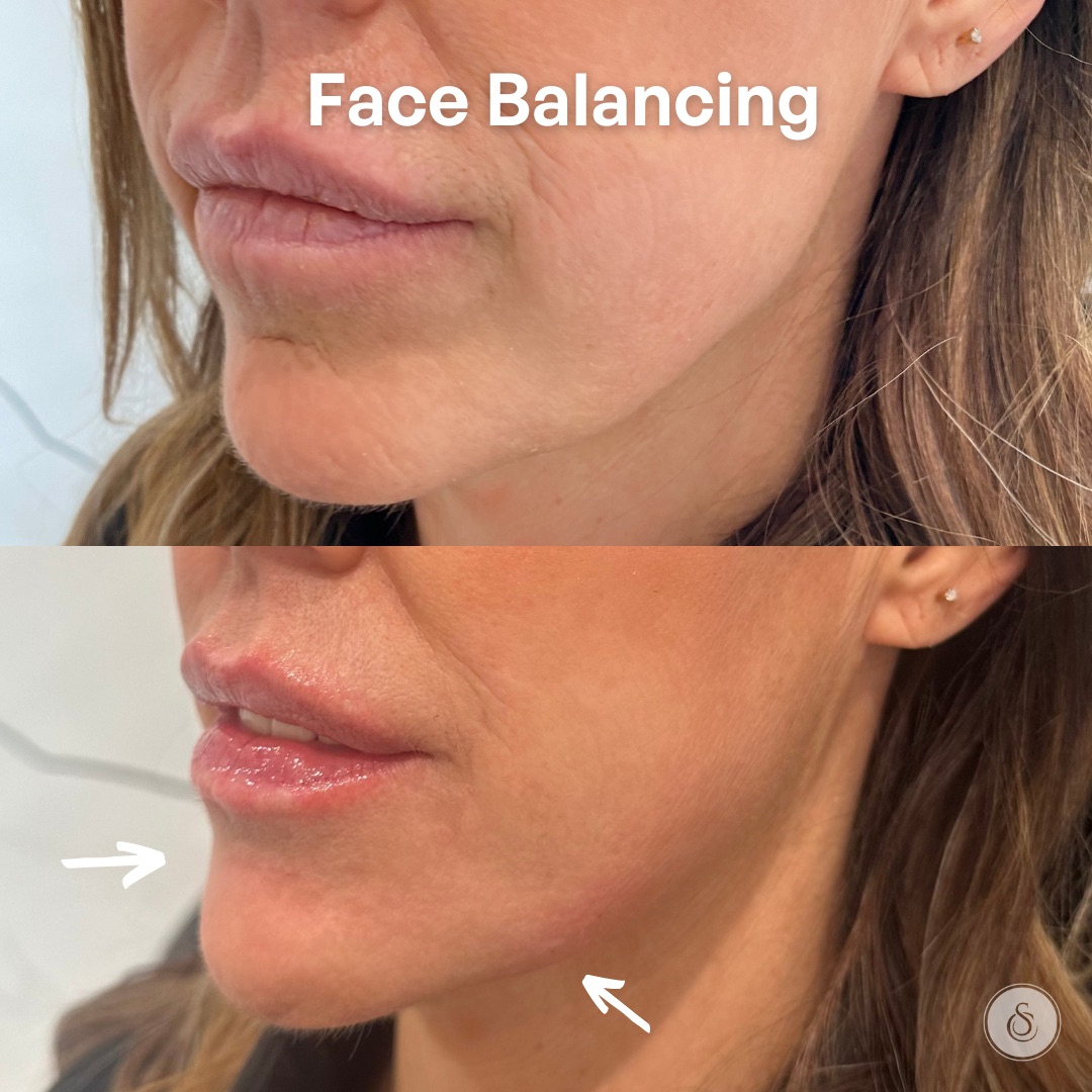 Sarasin Clinic Lips + kin filler face balancing