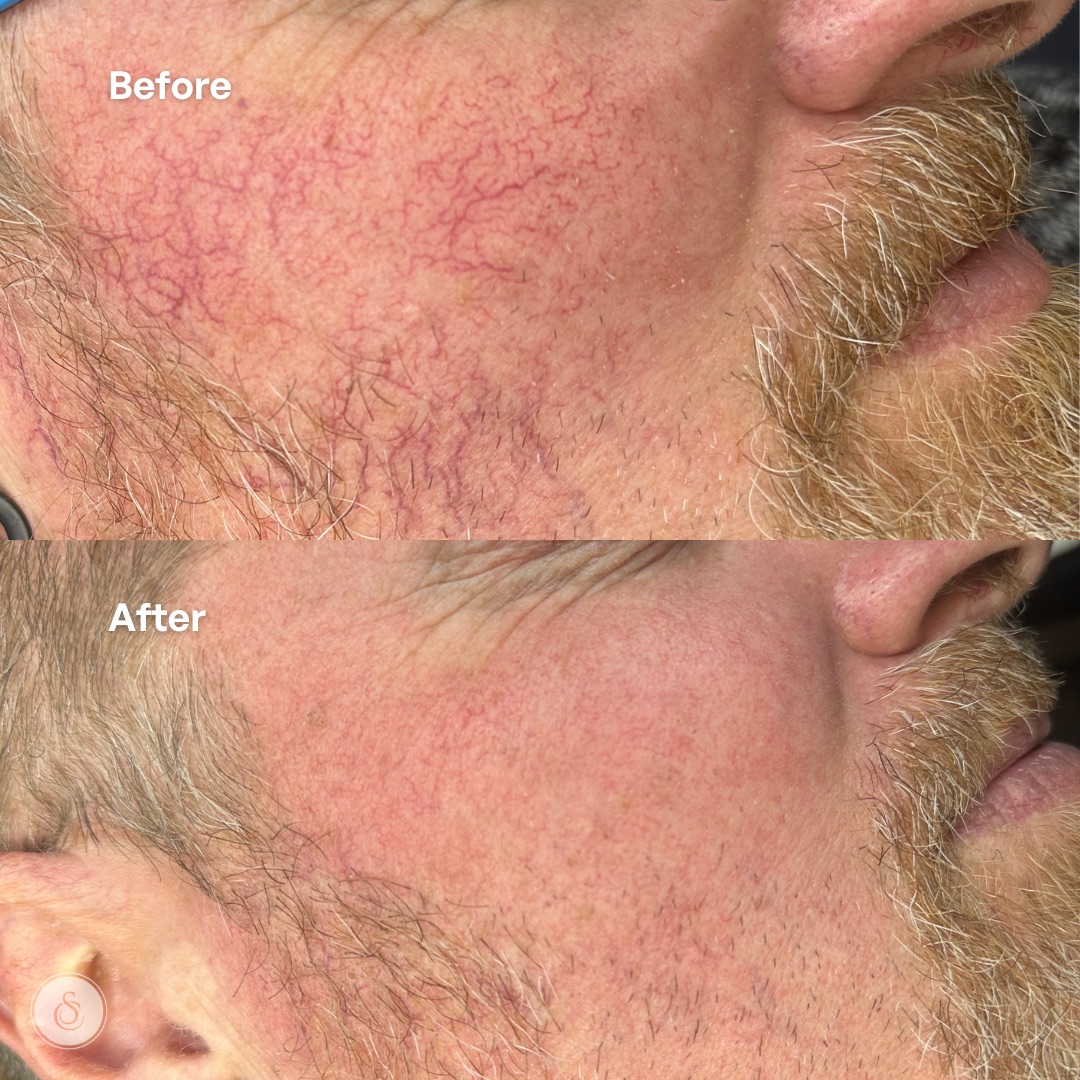sarasin clinic spider Vein Removal before and After man