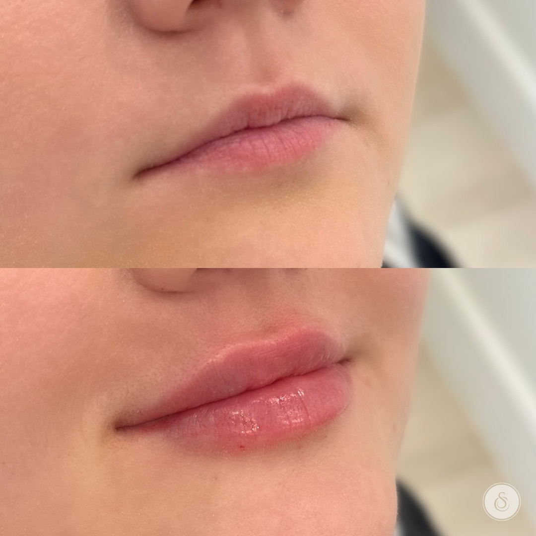 Realistic 1ml Lip Filler Before and After for Thin Lips