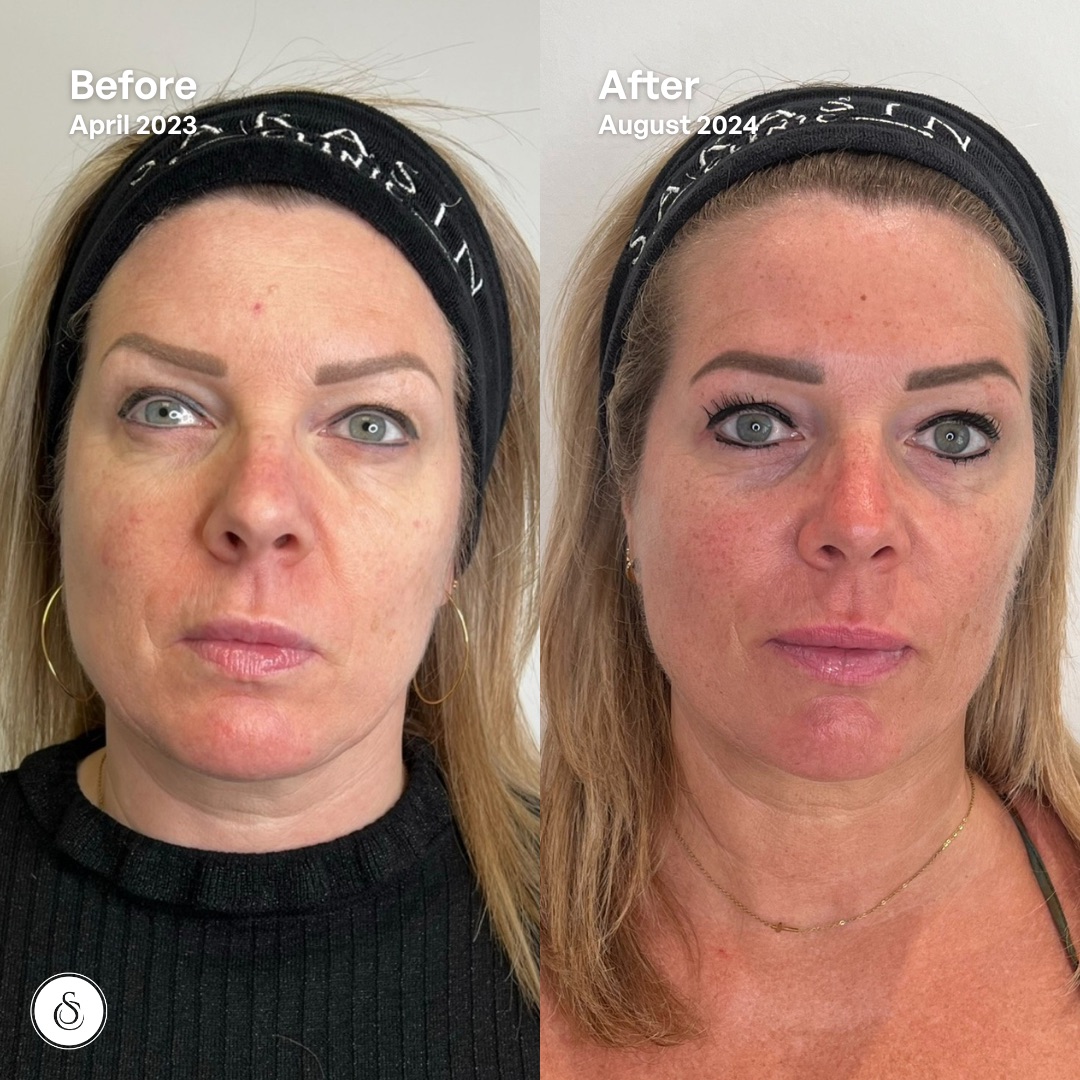 sculptra before and after woman face