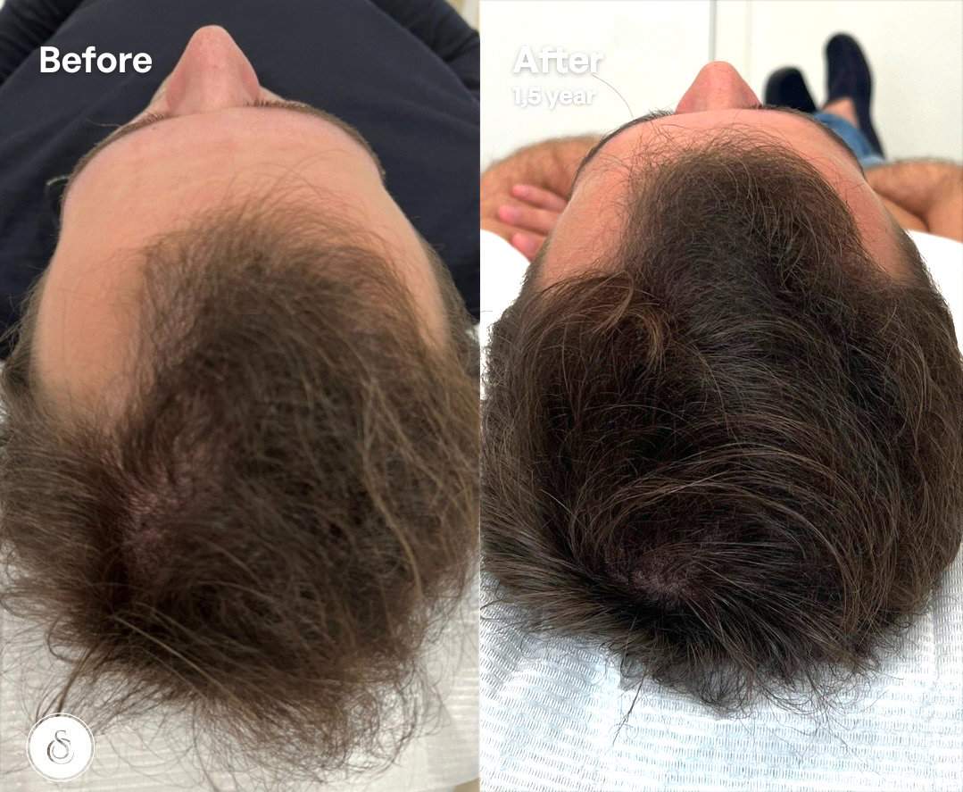 haar filler man voor en na 1,5 jaar