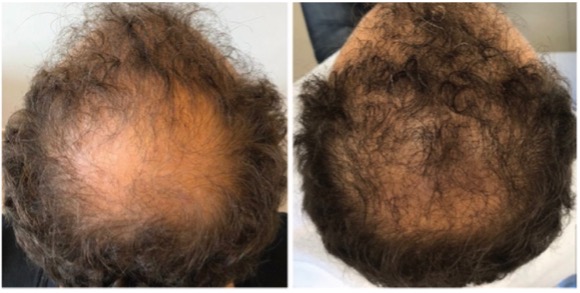 Reyu hair voor en na man