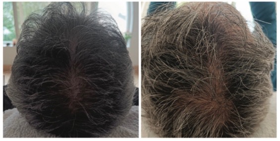 Reyu hair voor en na man