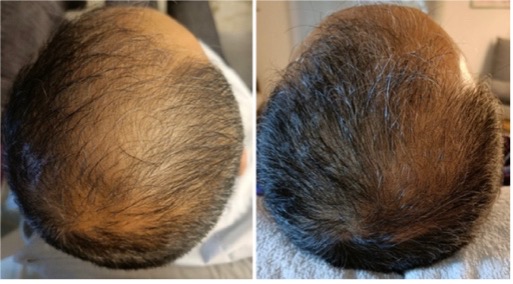 Reyu hair voor en na man