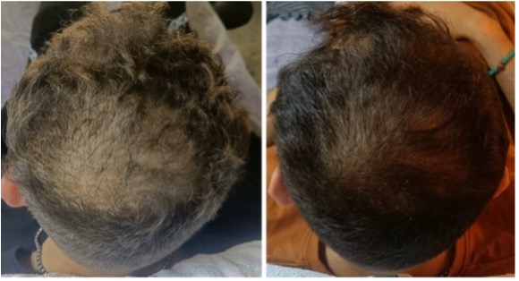 Reyu hair voor en na man