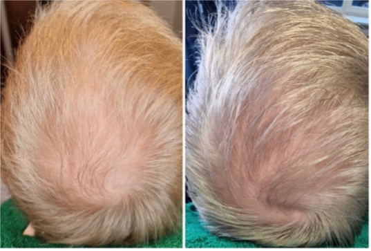 Reyu hair voor en na man blond haar