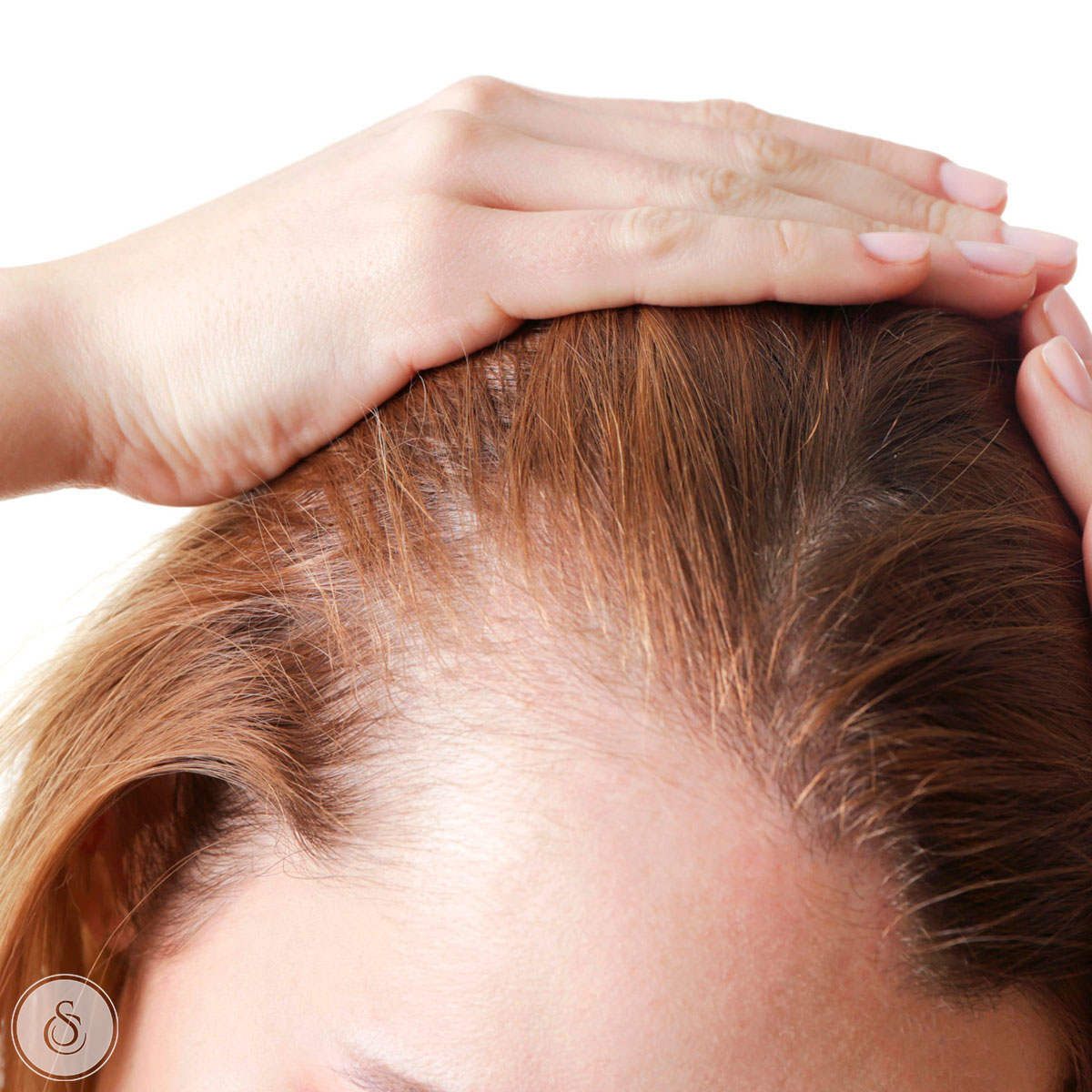 receding hairline woman