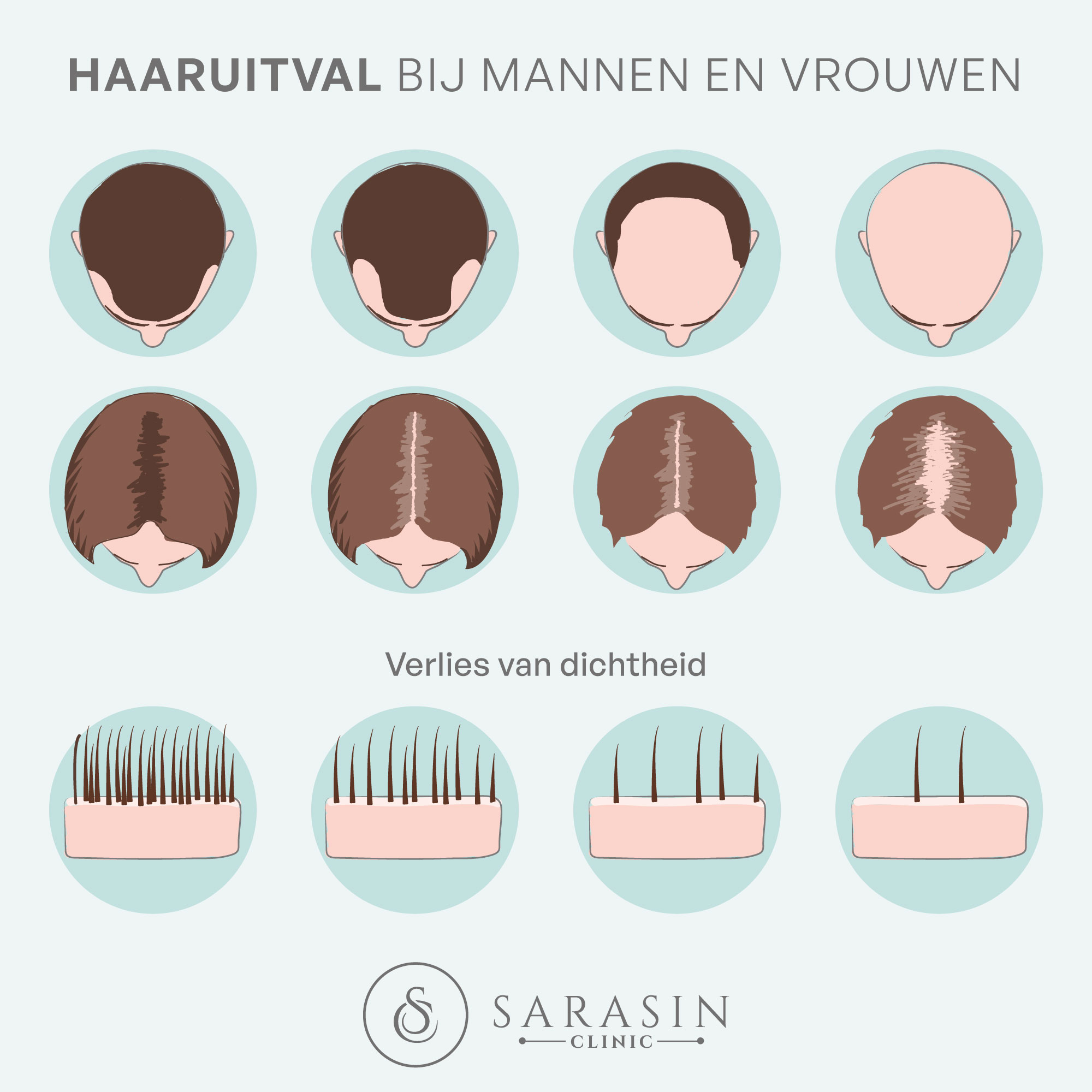 infographic haaruitval bij mannen en vrouwen