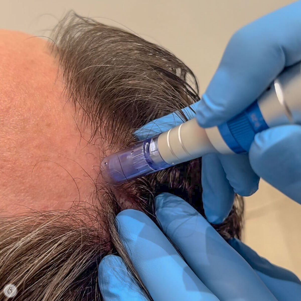 microneedling hair