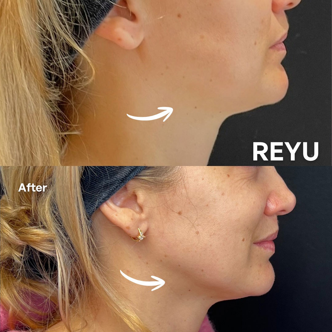 Reyu face profile before after young woman
