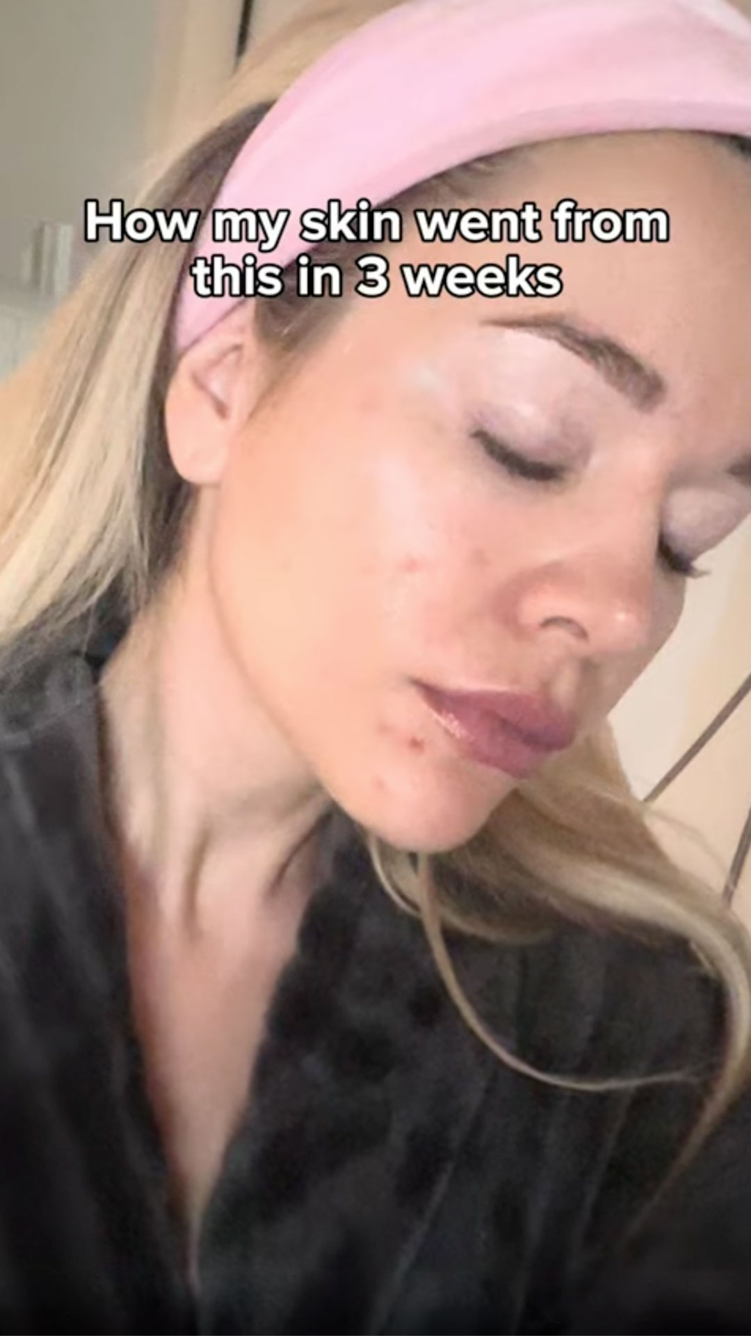 sarasin_Clinic_Get a Kbeauty glow before after short video: Get a Kbeauty glow before after