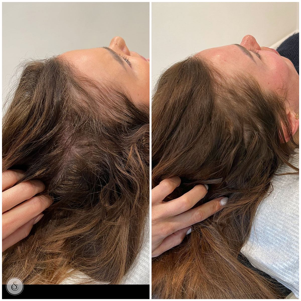 haarfiller vrouw voor en na